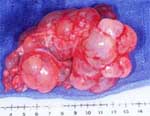 PLD Polycystic liver disease